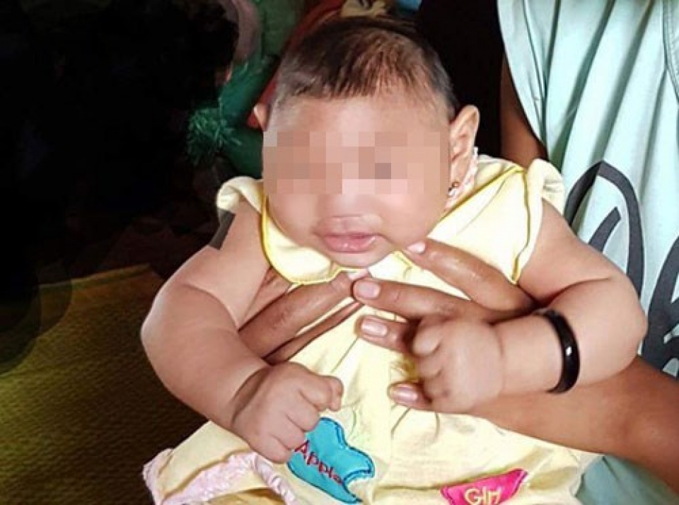 Bé gái 4 tháng tuổi ở Đắk Lắk là ca mắc hội chứng đầu nhỏ do virus Zika đầu tiên tại Việt Nam.